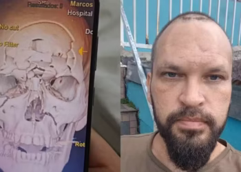Crânio de motociclista é triturado em batida no Paraná e ele se recupera praticamente sem sequelas: ‘Ficou tipo um quebra-cabeça’